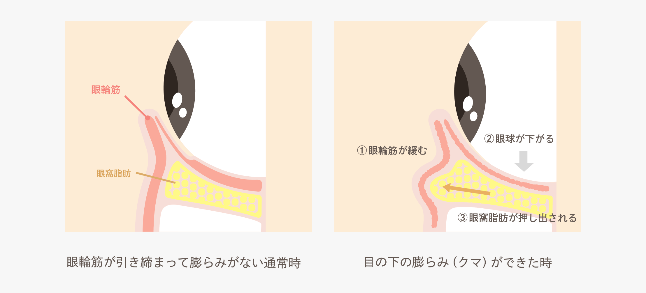 目の下のクマの原因とは