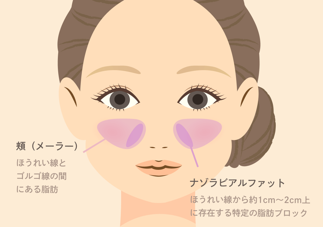 頬（メーラーファット）・ナゾラビアルファット