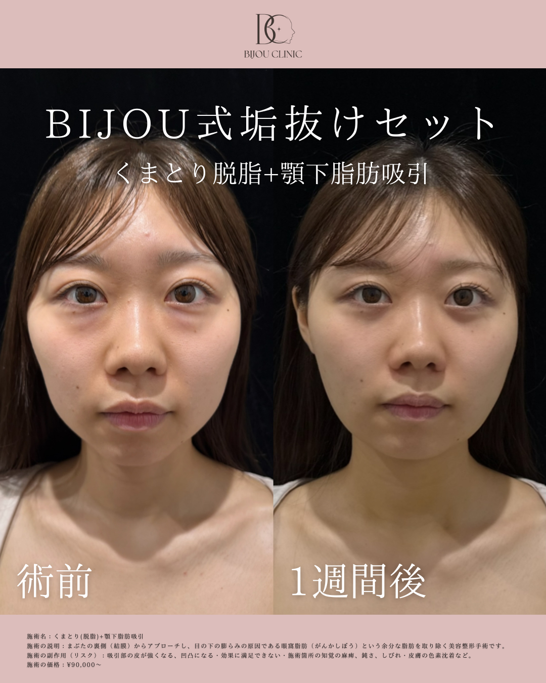 くま取り（脱脂）＋顎下脂肪吸引