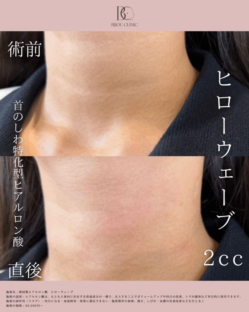 HILOWAVE(ヒローウェーブ)症例写真