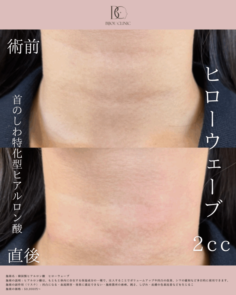 HILOWAVE(ヒローウェーブ)症例写真