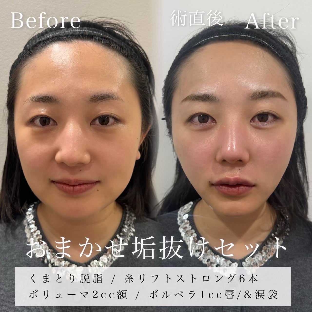 クマ取りスタンダード（脱脂）・糸リフト（ストロング６本）・ヒアルロン酸（額、涙袋、口唇）