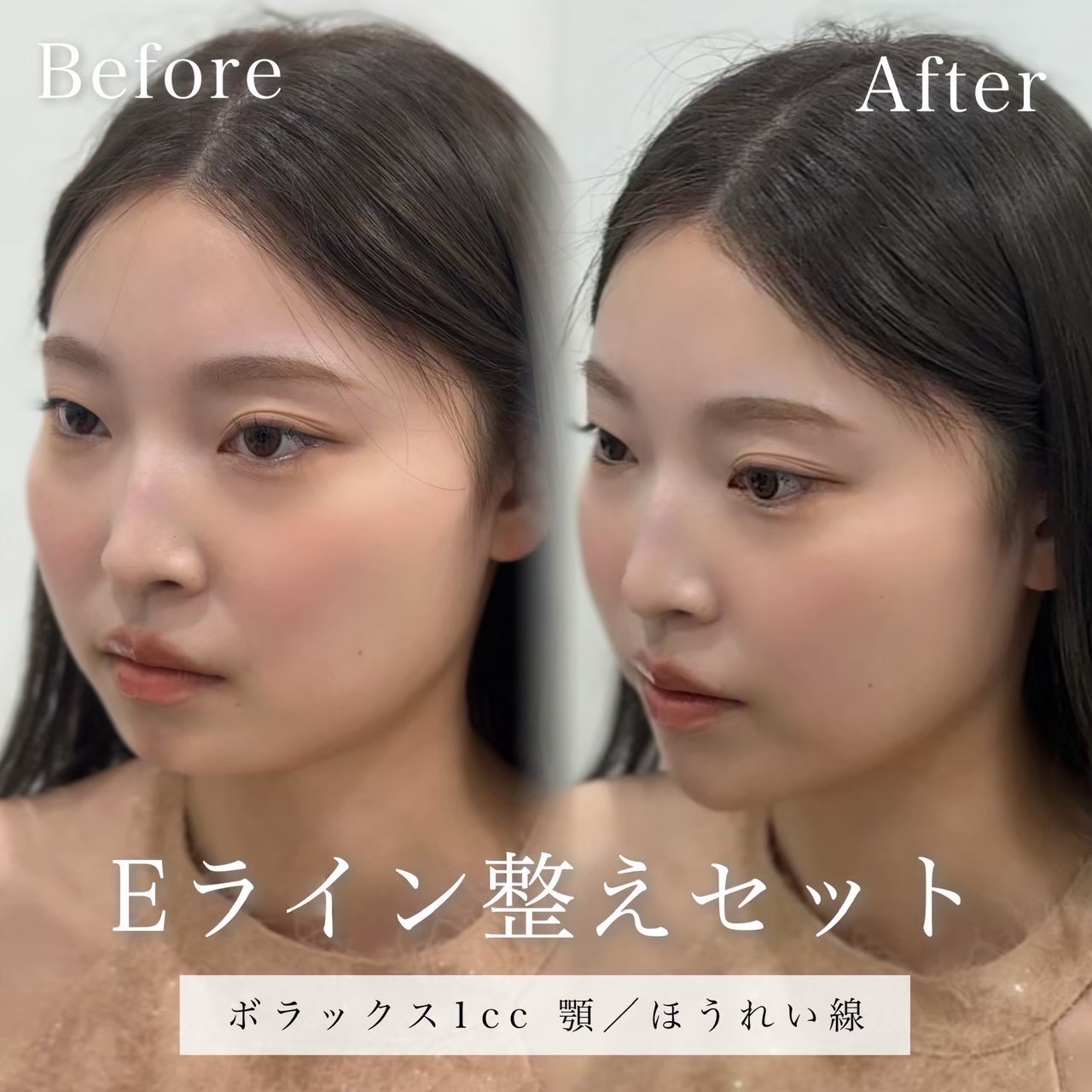 ヒアルロン酸（顎、ほうれい線）