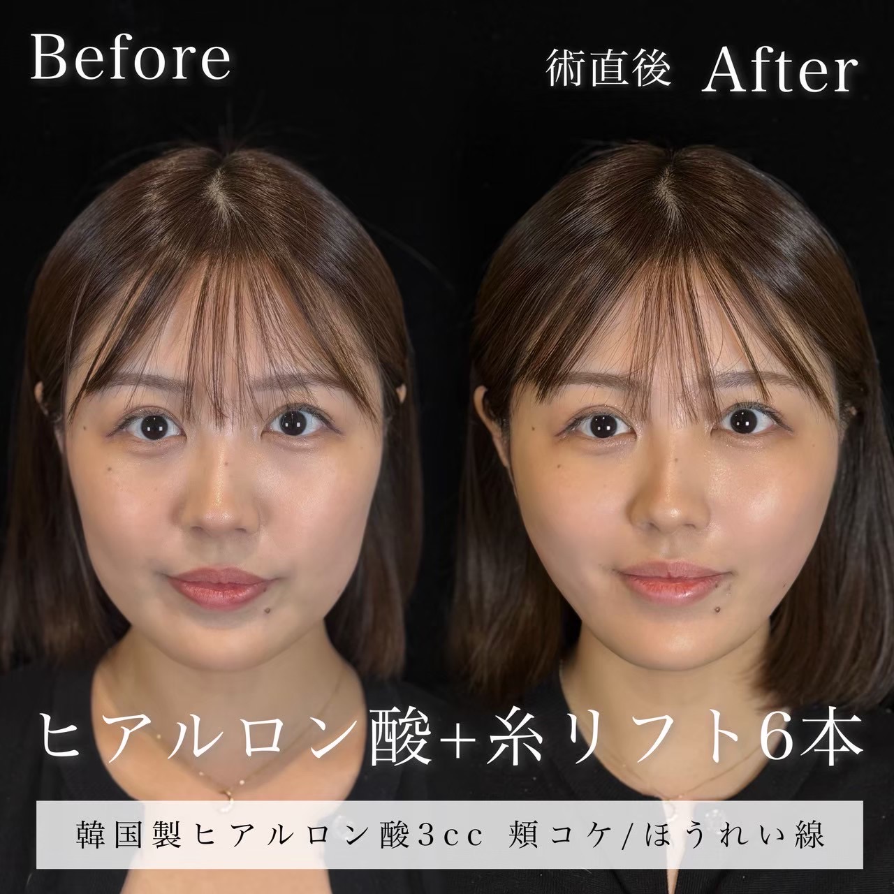 ヒアルロン酸（頬、ほうれい線）・糸リフト（エターナル６本）