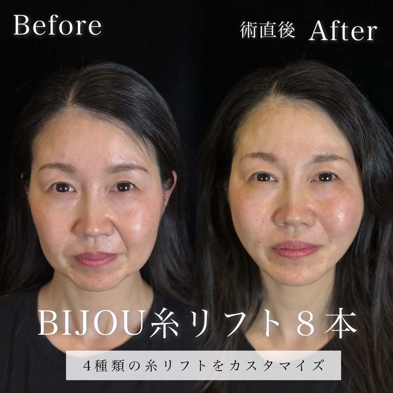 糸リフト（テスリフト４本、エターナル４本）