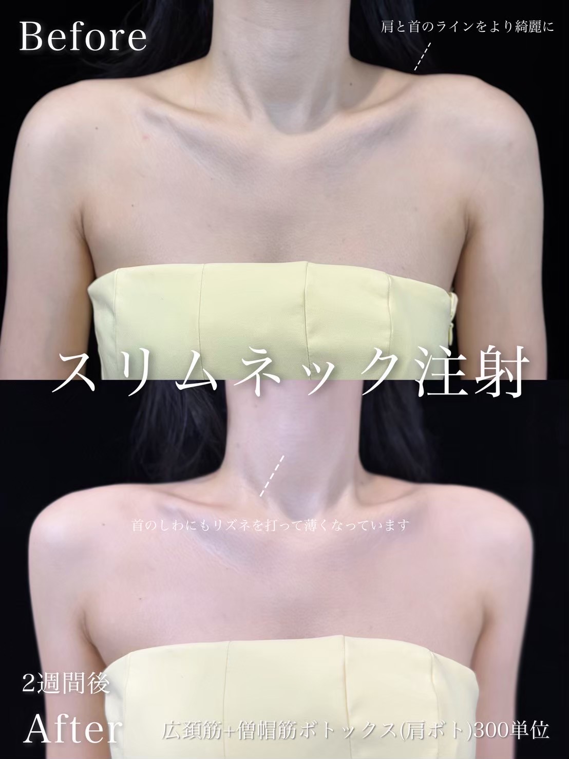 ボトックス（広頚筋、僧帽筋、肩）