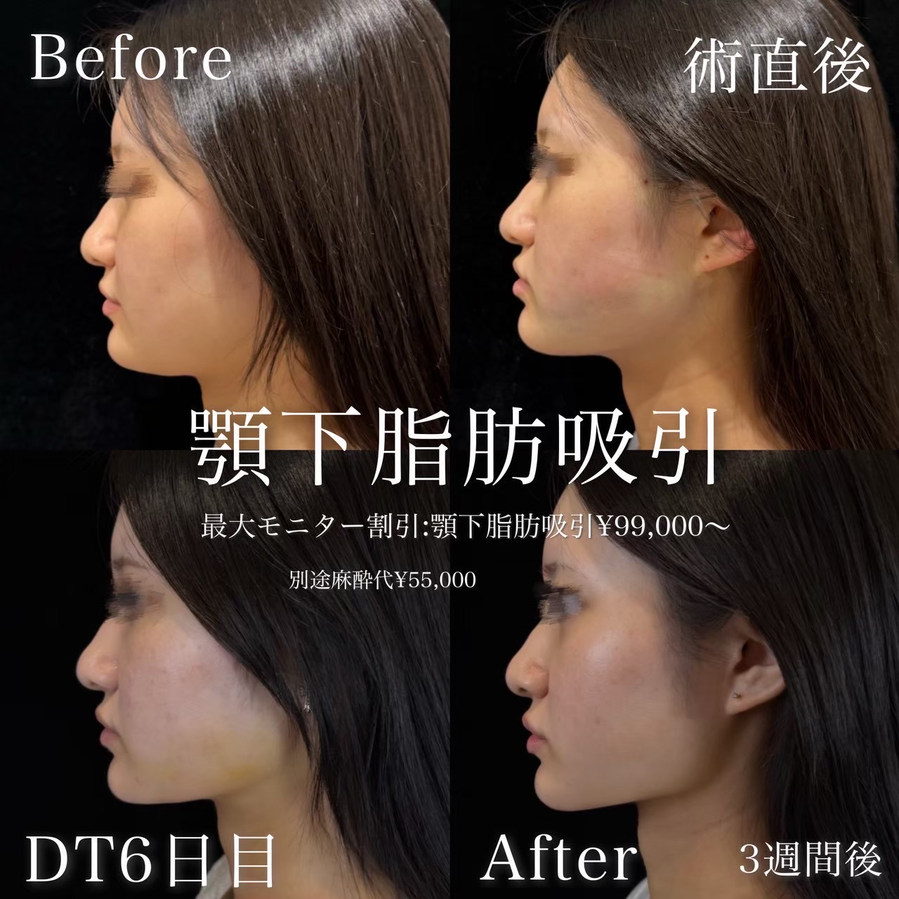 脂肪吸引（顎下）