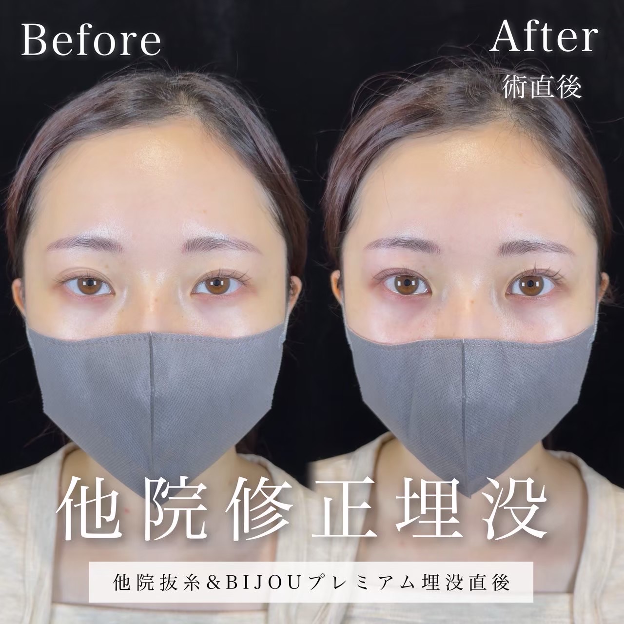 埋没（BIJOUプレミアム右目）