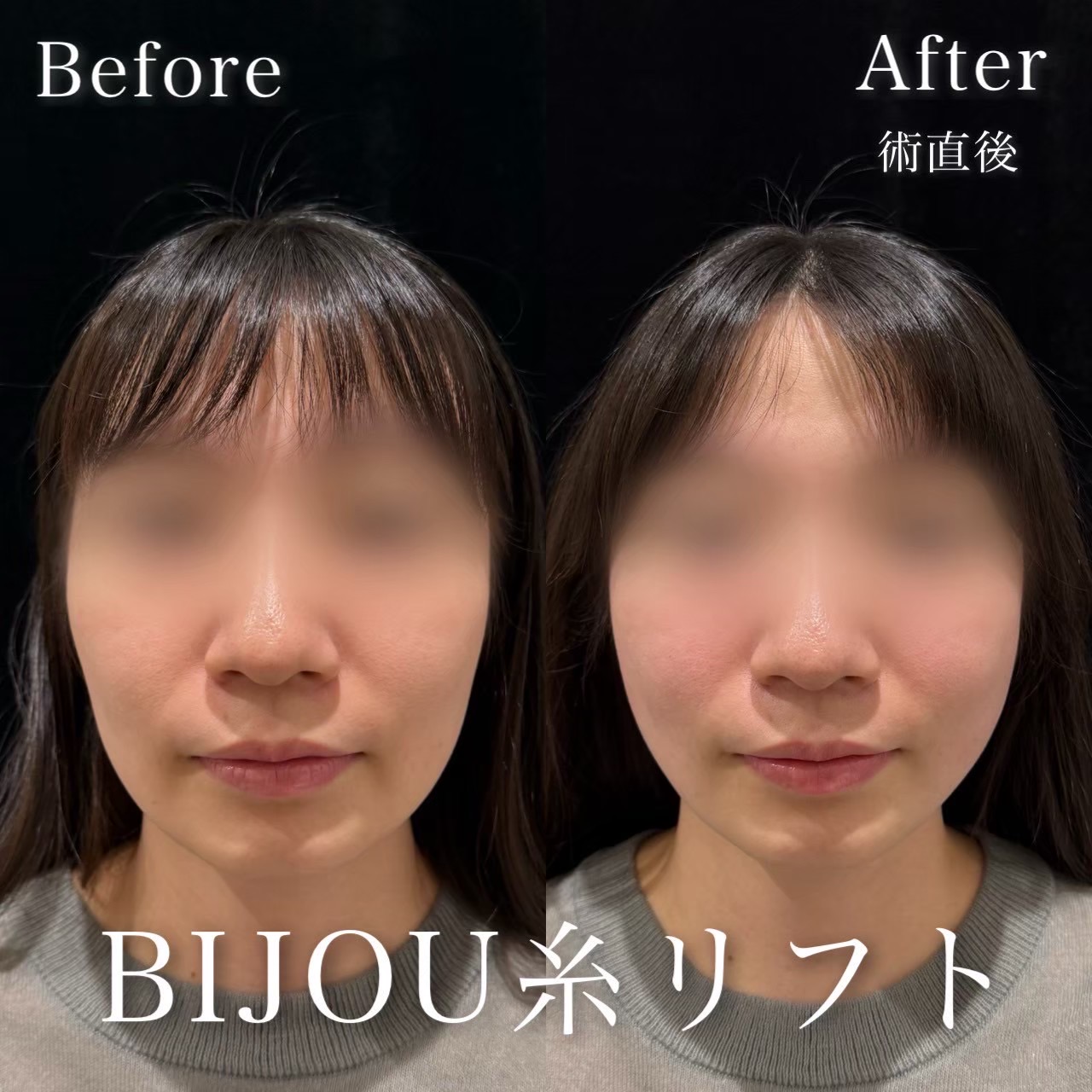 テスリフト４本ストロング６本