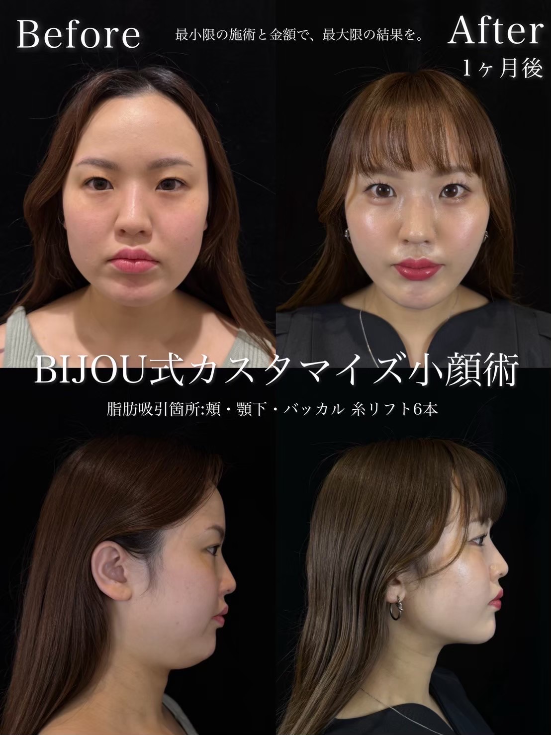 脂肪吸引（バッカル・頬顎下・糸リフト6本）