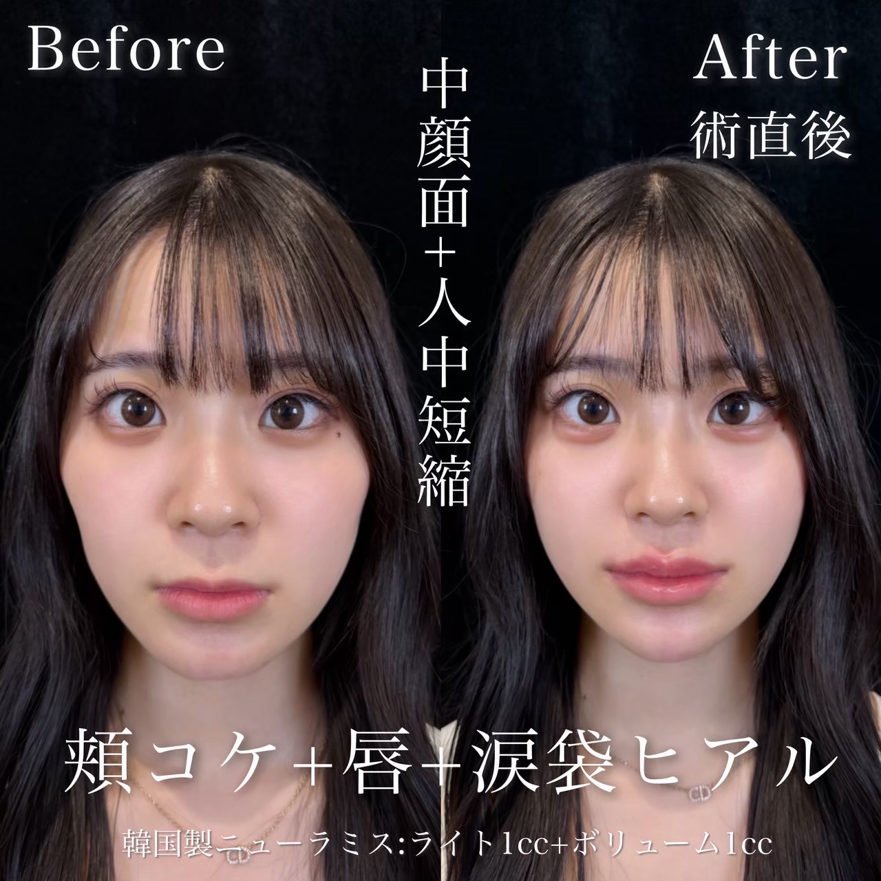 ヒアルロン酸（頬・涙袋・唇）