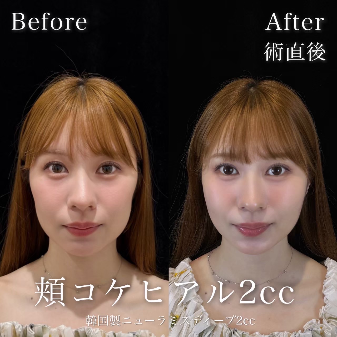 ヒアルロン酸（頬コケ）