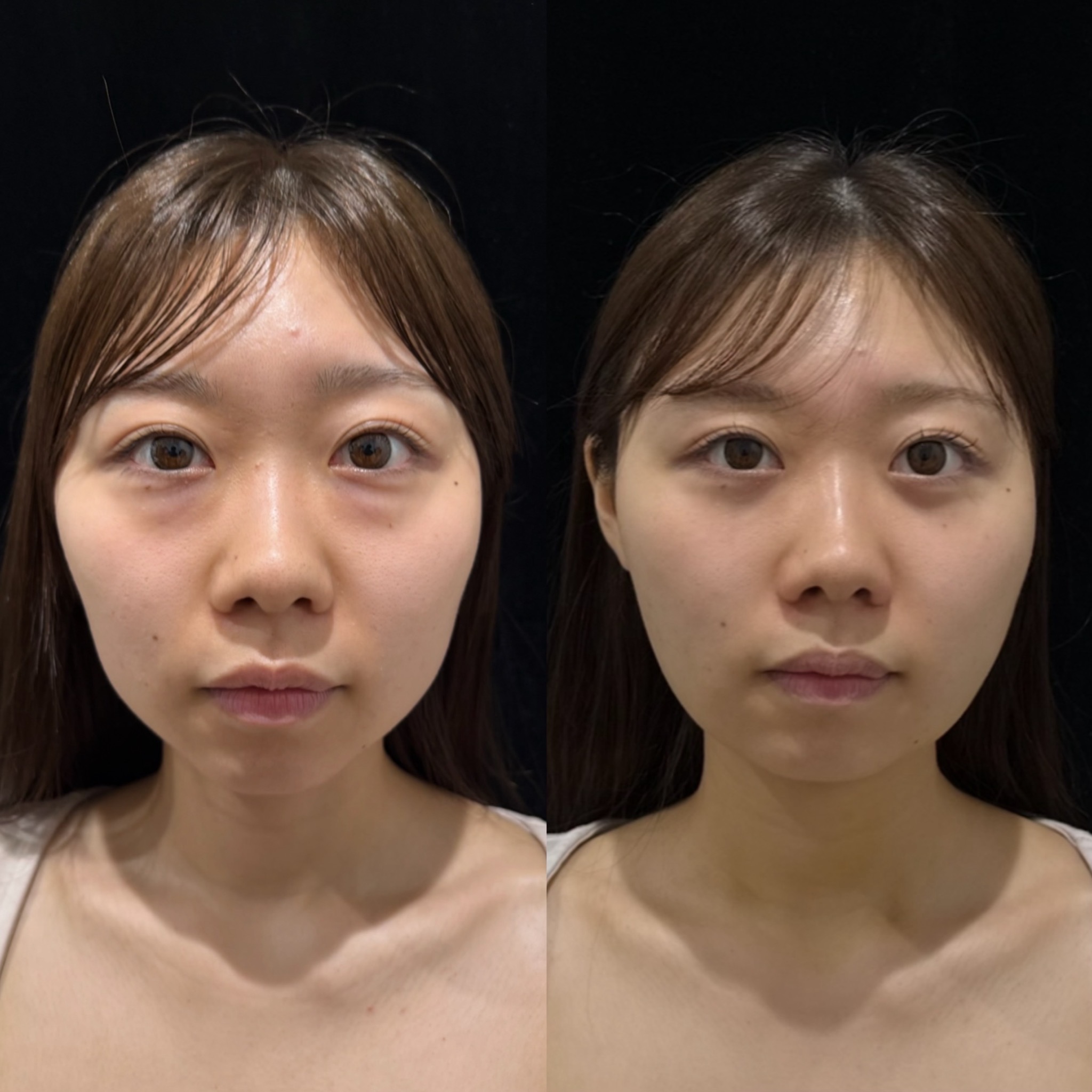 くま取り（脱脂）＋顎下脂肪吸引