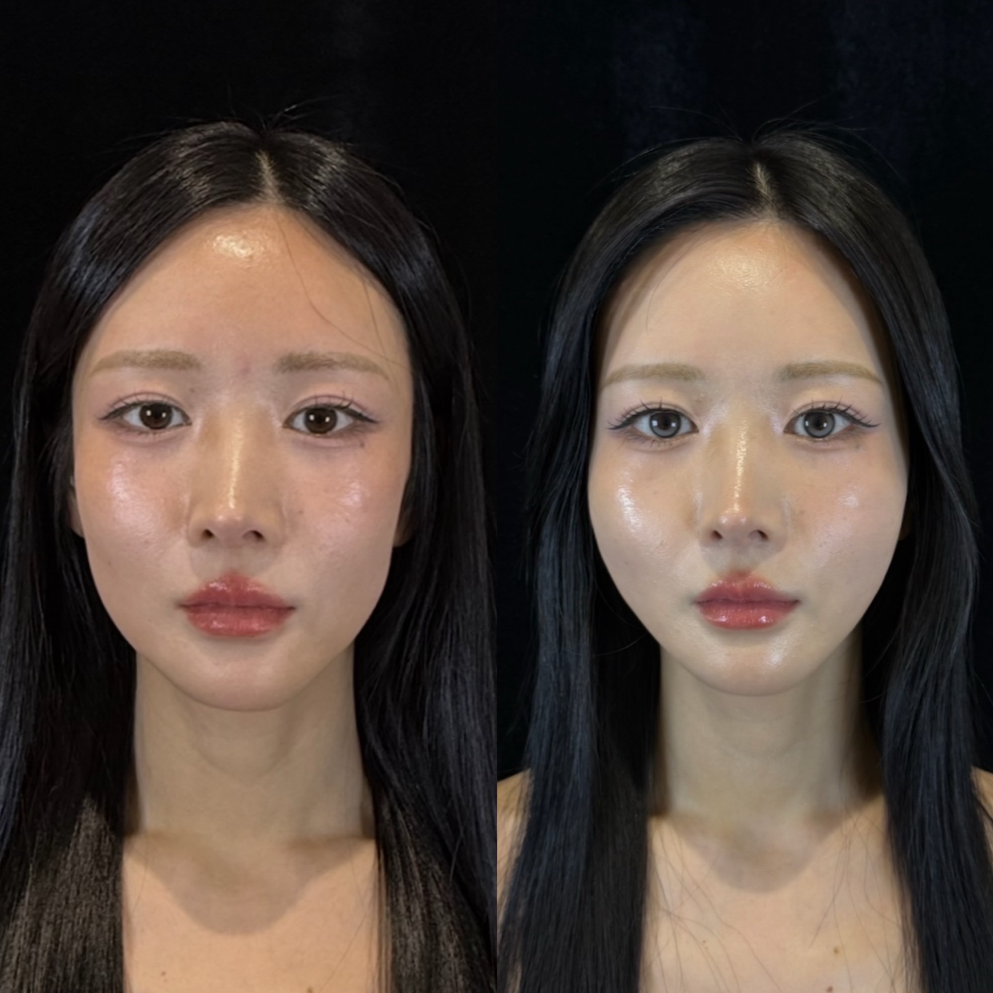 糸リフト（エターナル）6本