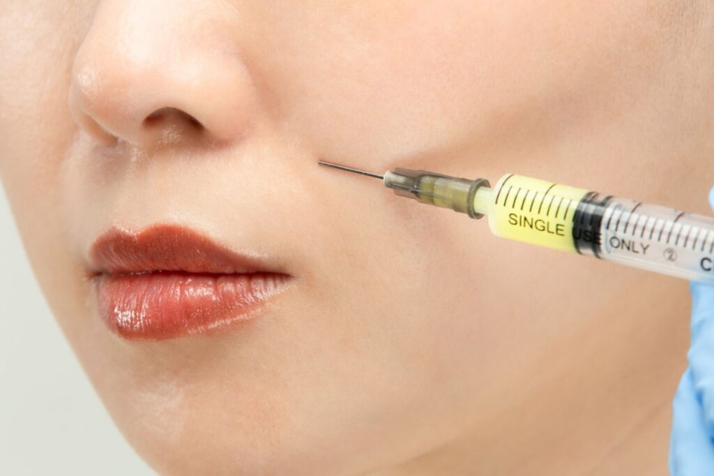 ほうれい線あたりにヒアルロン酸注射を打つ女性