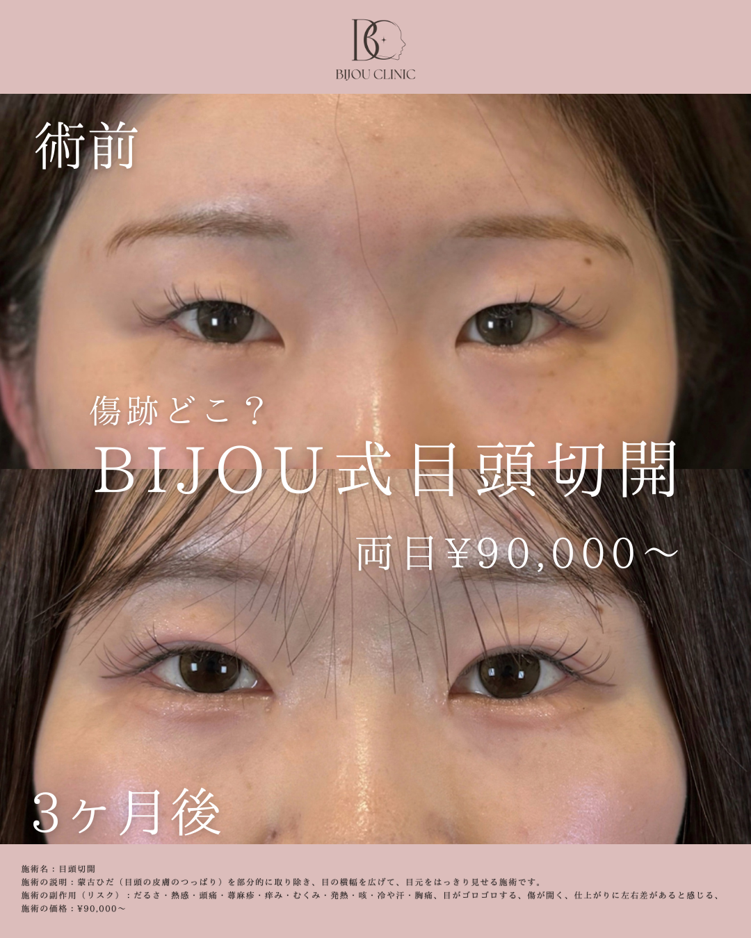 BIJOU式目頭切開