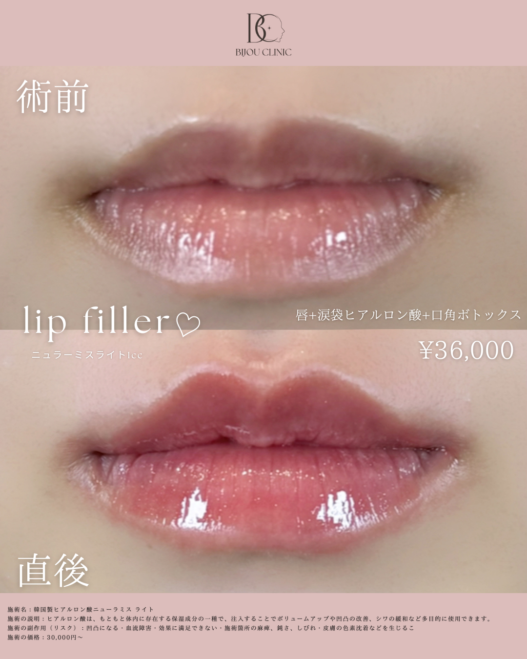 唇ヒアルロン酸