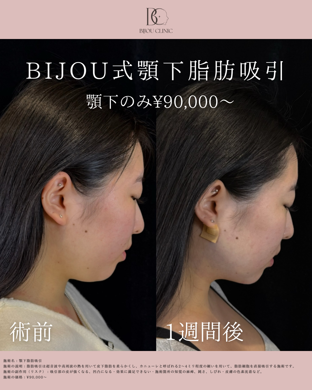 BIJOU式顎下脂肪吸引