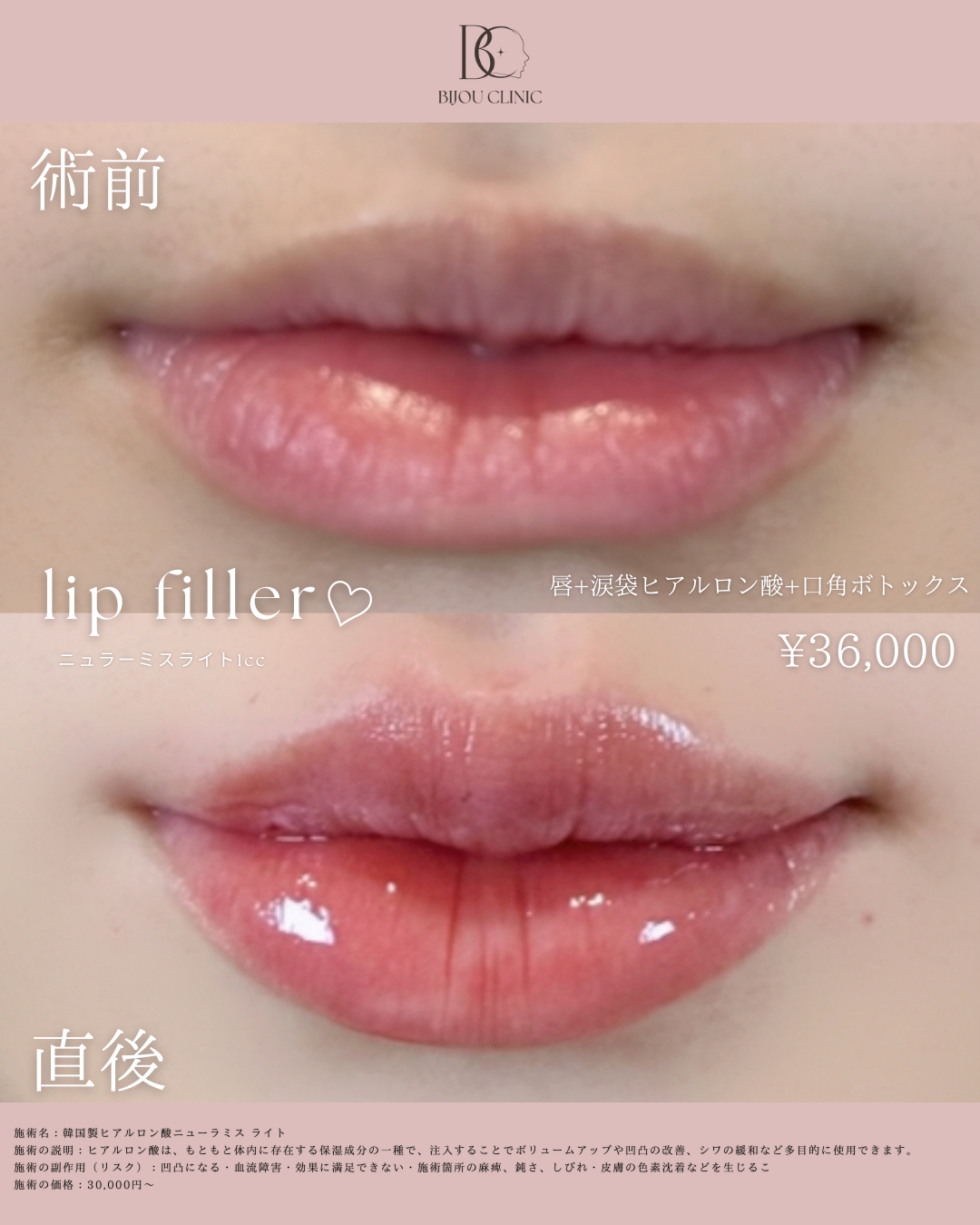 唇ヒアルロン酸