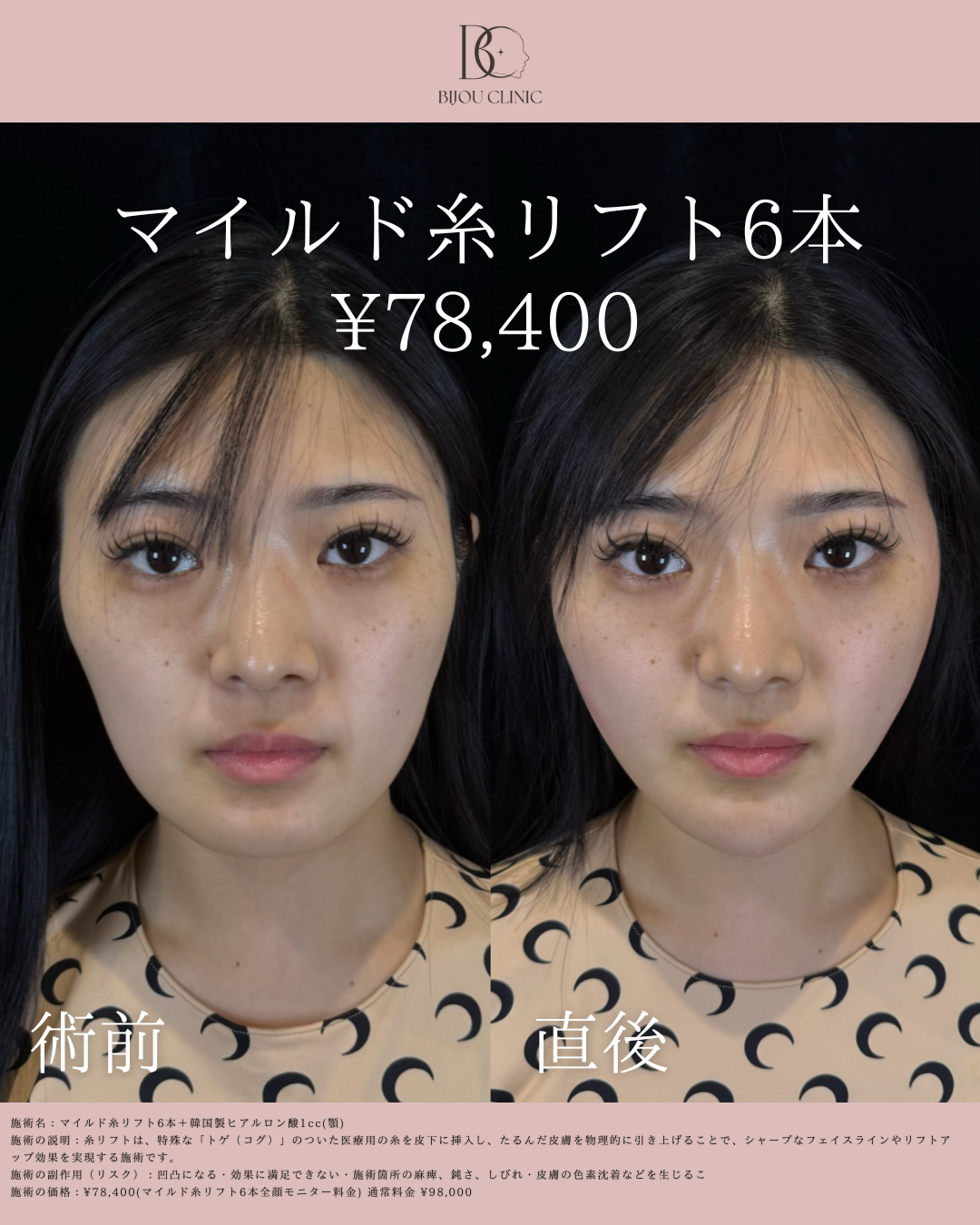 マイルド糸リフト６本(全顔モニター）