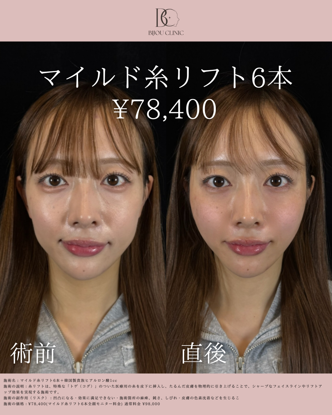 マイルド糸リフト6本