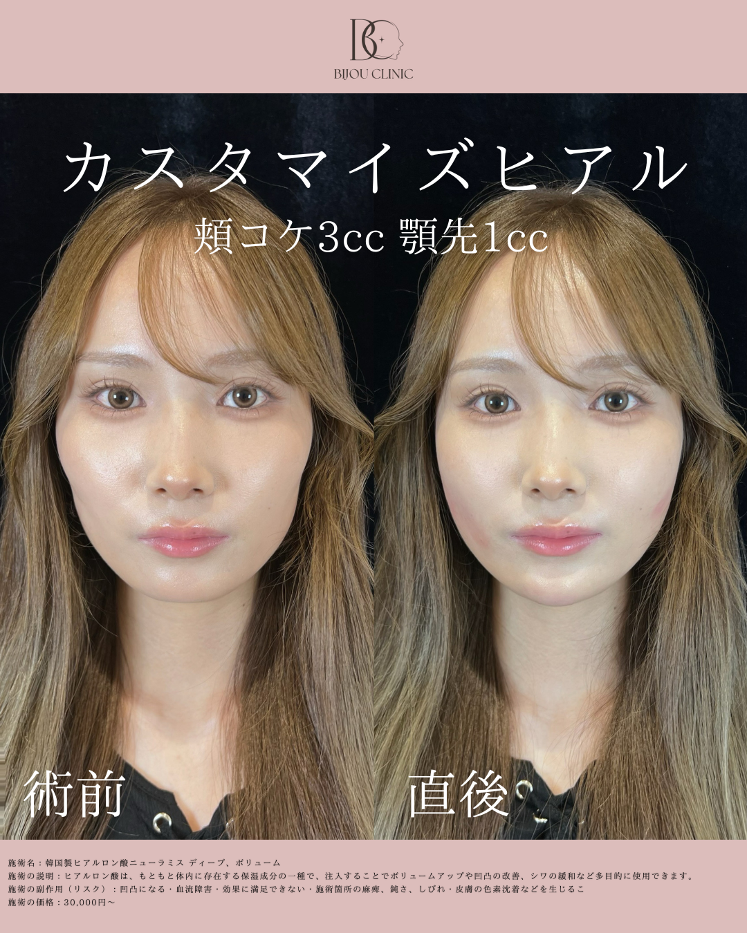 ヒアルロン酸(頬3cc、顎先1cc)