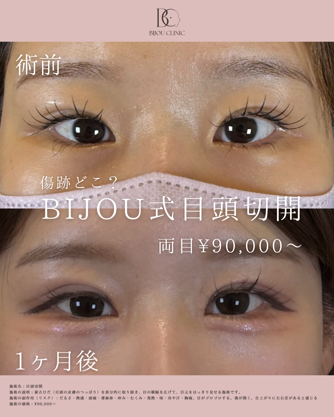 BIJOU式目頭切開