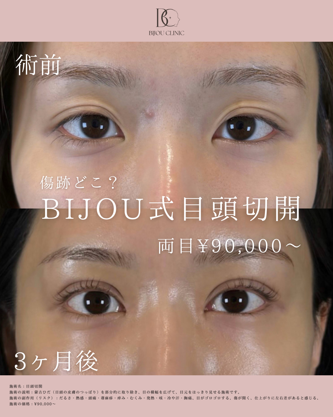 BIJOU式目頭切開