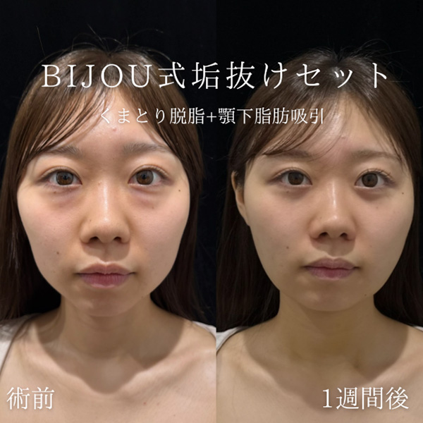 くま取り（脱脂）＋顎下脂肪吸引