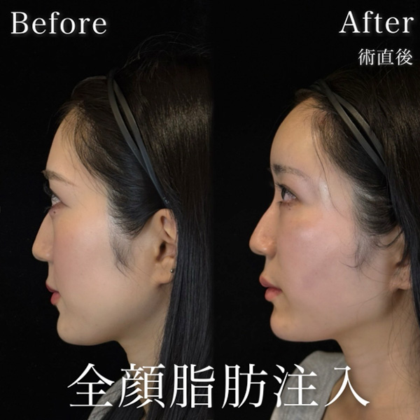 全顔脂肪注入