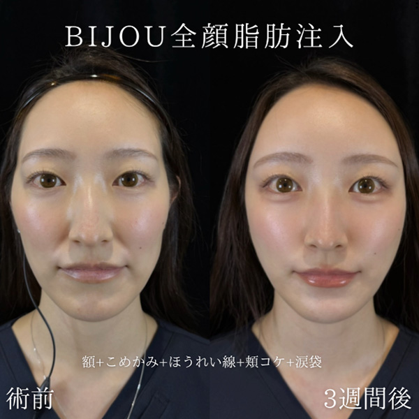 全顔脂肪注入(額、こめかみ+ほうれい線+頬+涙袋)