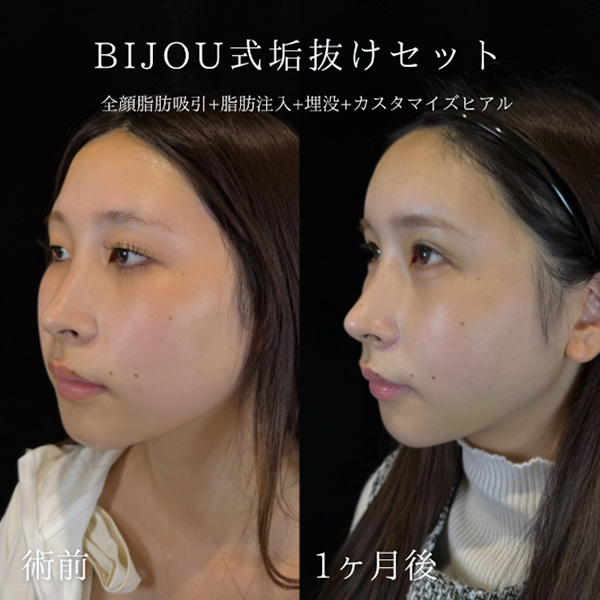 脂肪吸引&脂肪注入+埋没+ヒアルロン酸(涙袋)