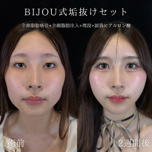 脂肪吸引&脂肪注入+埋没+ヒアルロン酸(涙袋)