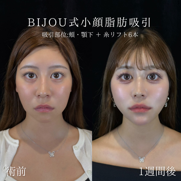 頬・顎下脂肪吸引+糸リフト6本