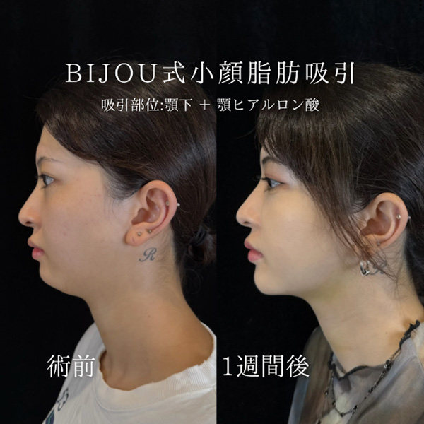 顎下脂肪吸引+ヒアルロン酸(顎)