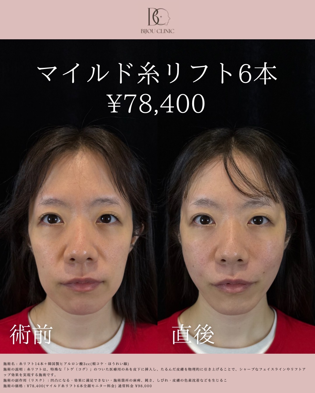 マイルドリフト6本