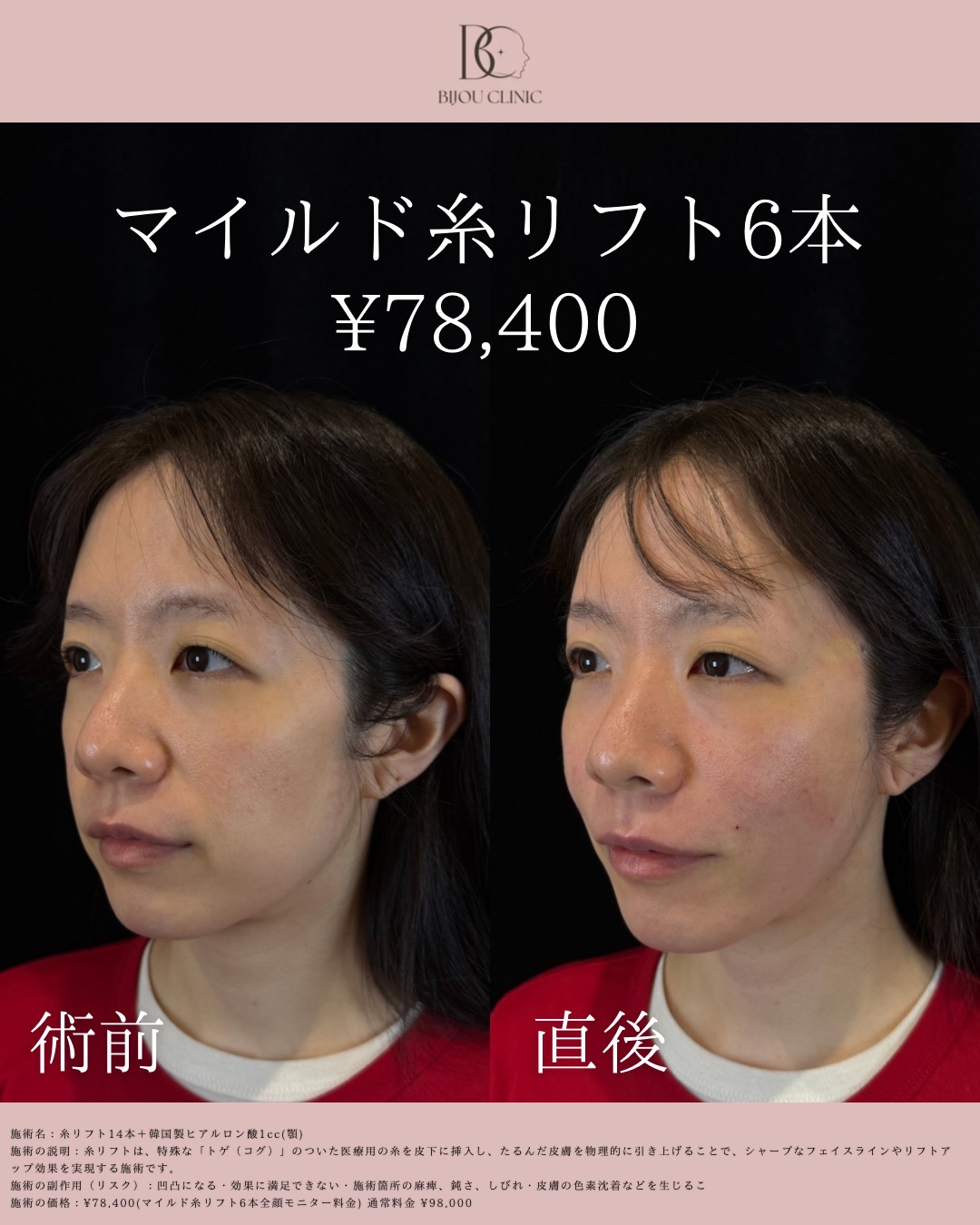 マイルドリフト6本