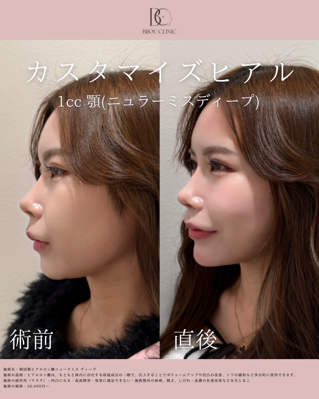 顎ヒアルロン酸