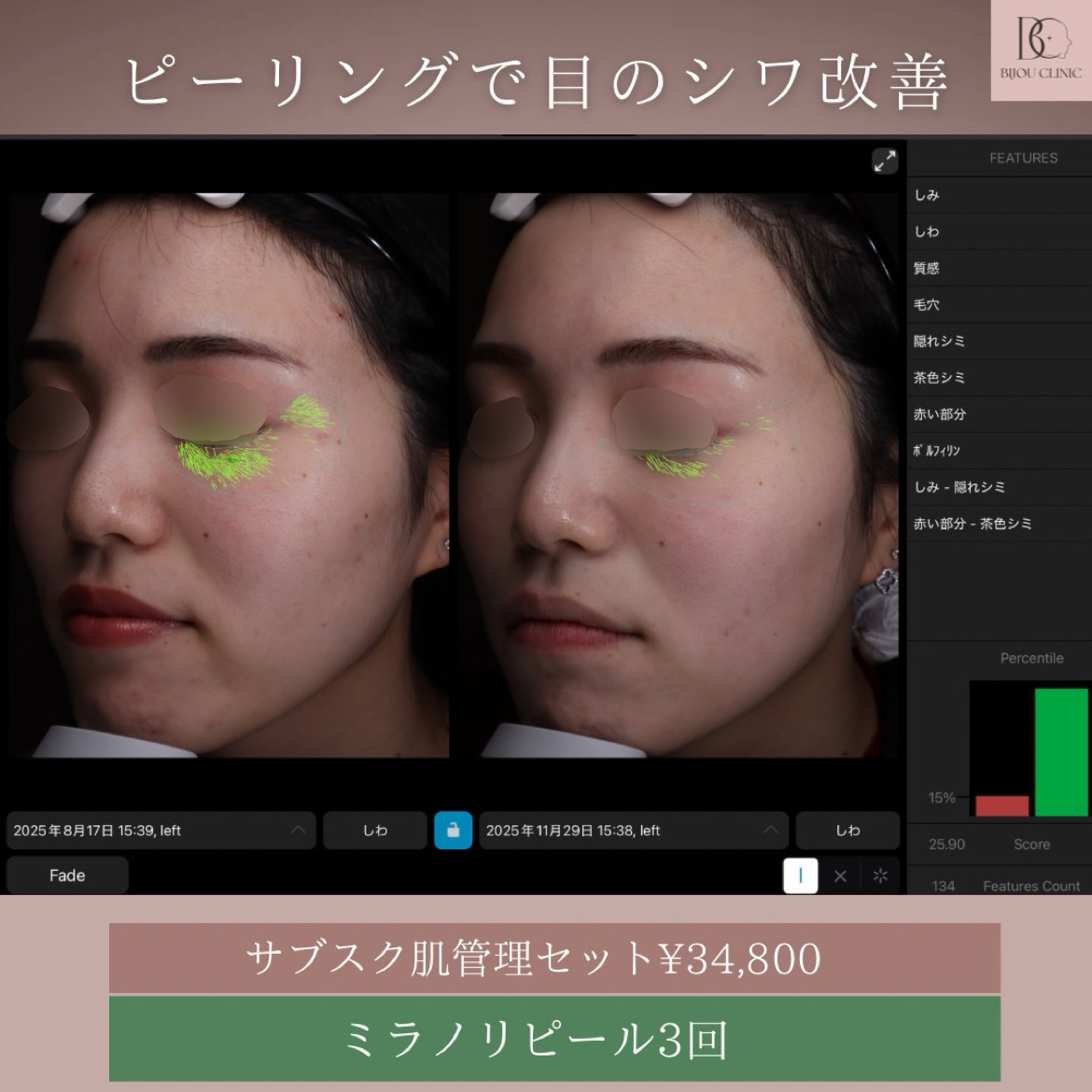 ミラノリピール3回