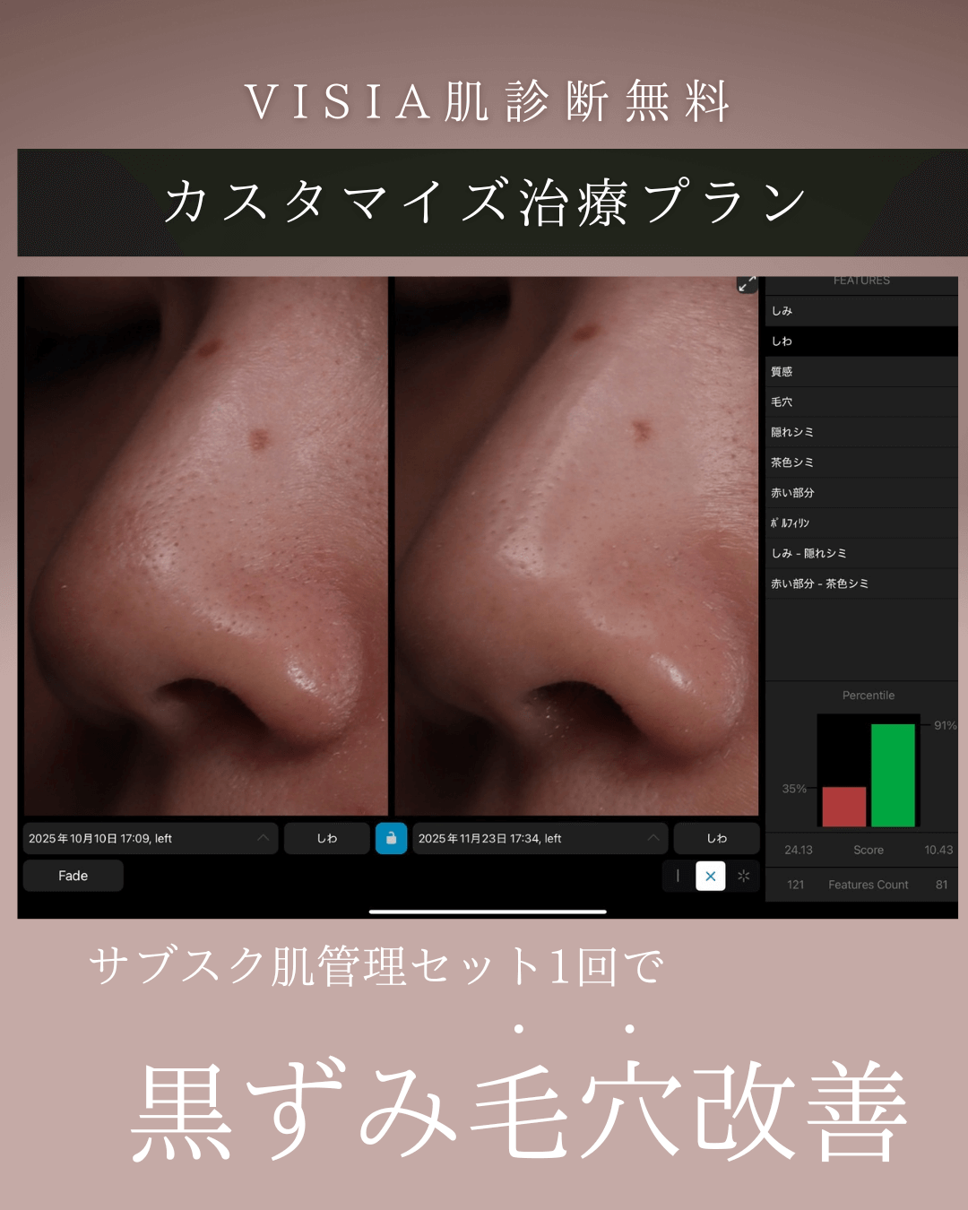 ハイドラジェントル(ポアレス)、ミラノリピール、ケアシス(レナトゥスTa)