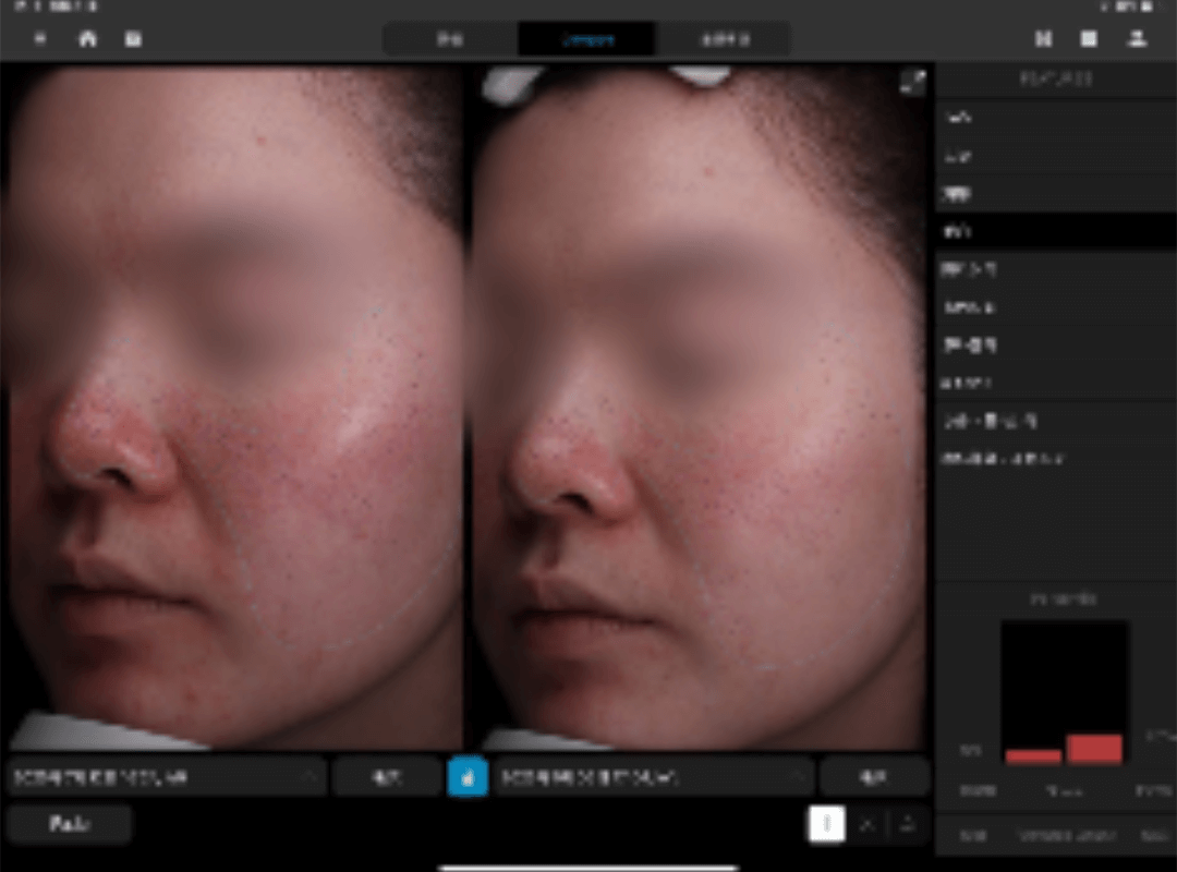 鎮静ケア、スキンケア変更、ミノマイシン内服、ロゼックス外用提案