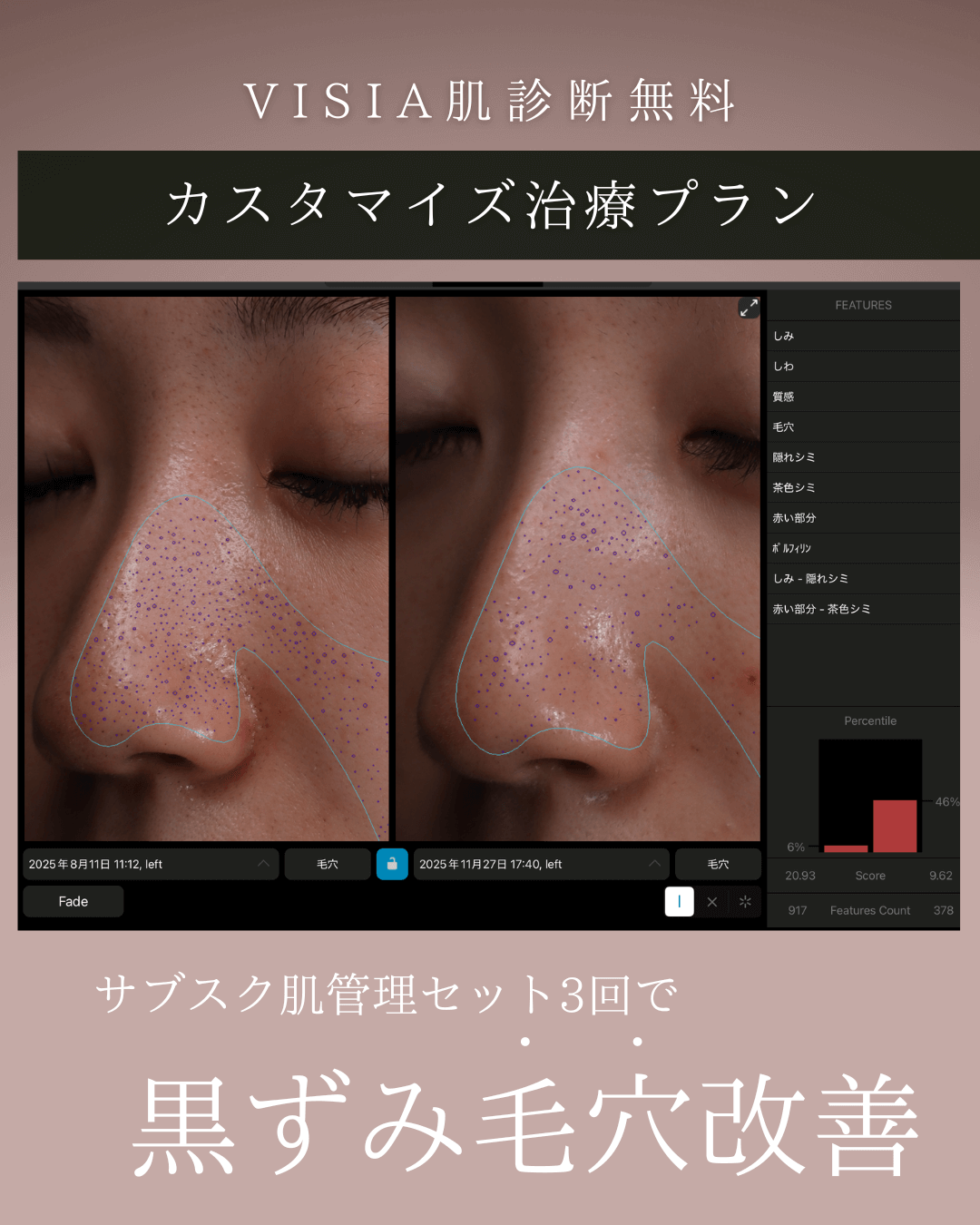 ミラノリピール、ケアシス、鎮静ライト3回