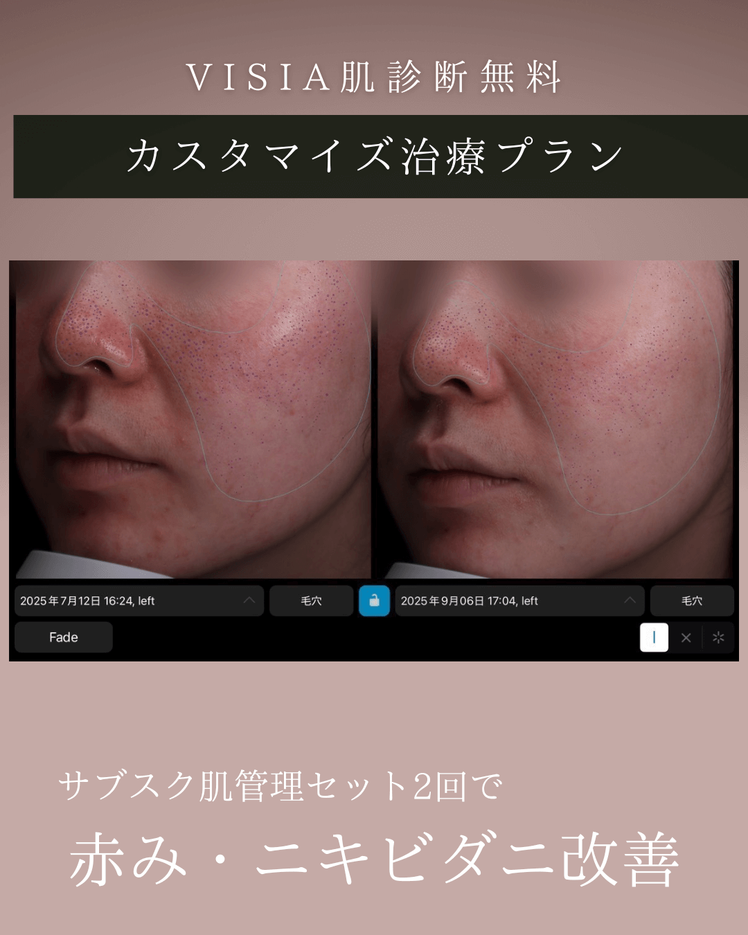 鎮静ケア・スキンケア変更・内服