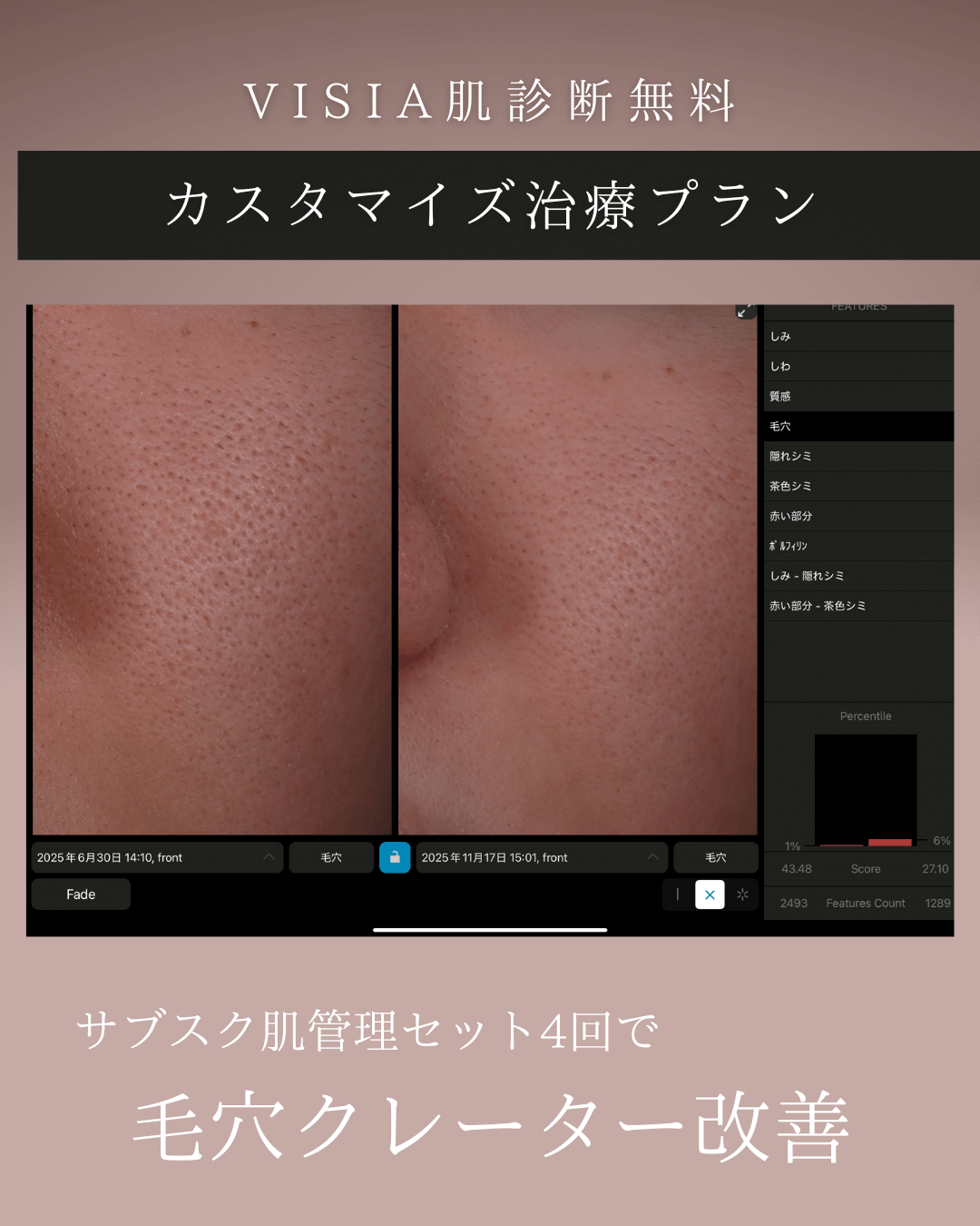 サブジジョン＋ヒアルロン酸、ミラノリピール4回、ケアシス、毛穴カクテル