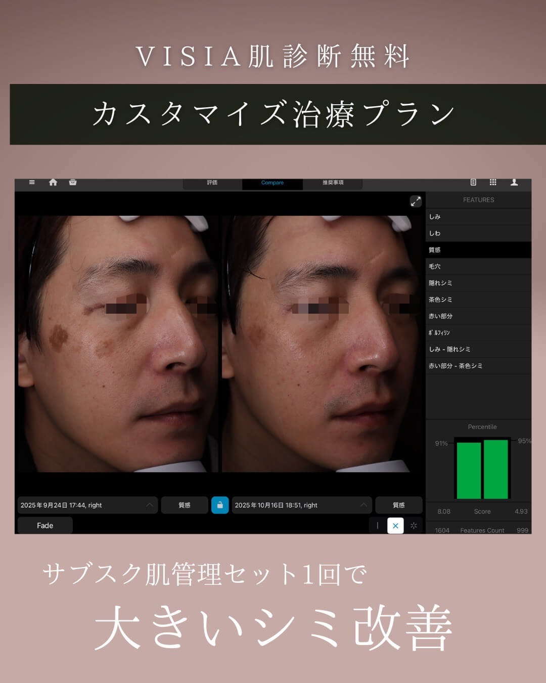 全顔シミ取り放題(老人性色素斑)