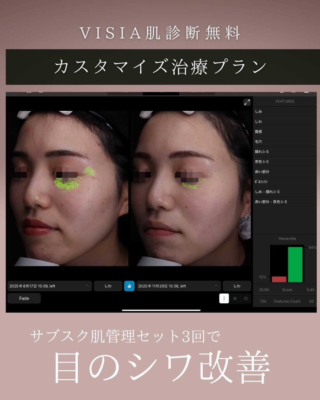 ミラノリピール3回