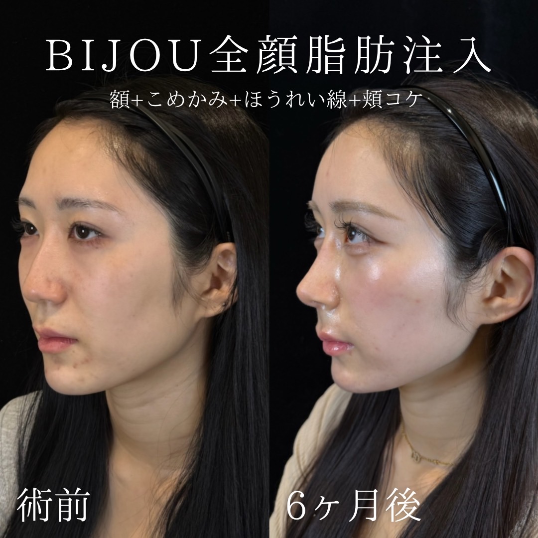 BIJOU全顔脂肪注入