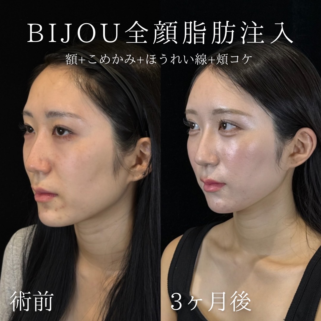BIJOU全顔脂肪注入