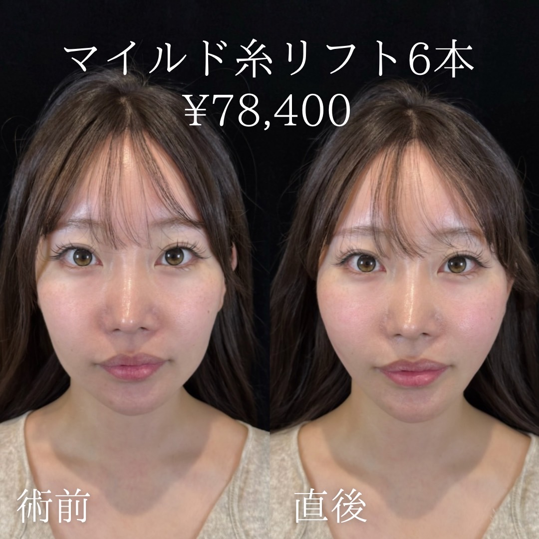 マイルド糸リフト6本