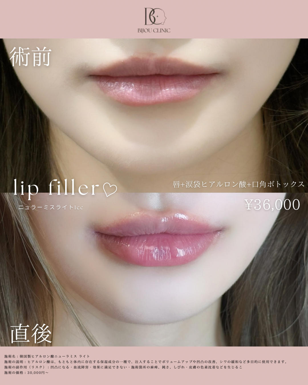 唇＋涙袋ヒアルロン酸＋口角ボトックス